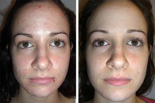 Пилинг лица химический, ретиноевый. Фото до и после, цены.