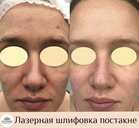 результат процедуры лазерной шлифовки