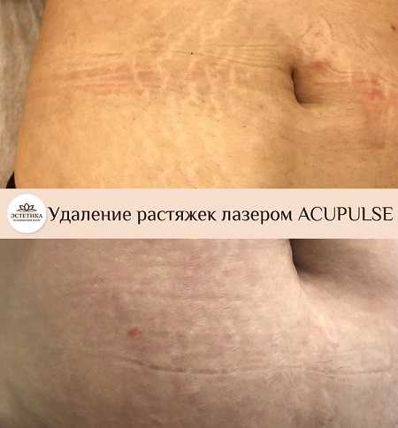 лазерное удаление растяжек, результат процедуры