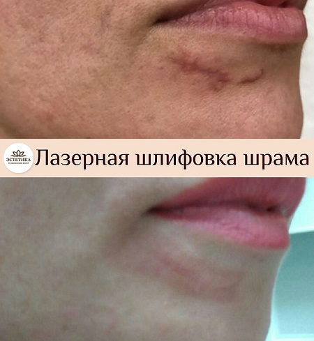 результат процедуры шлифовки шрама