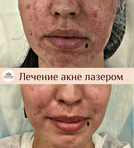 результат процедуры лечения акне