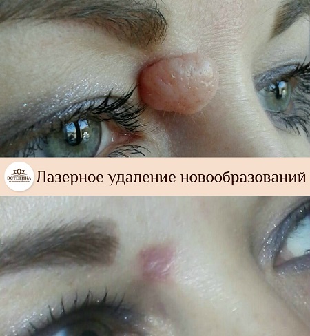 результат удаления лазером новообразования