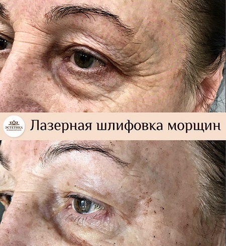 результат процедуры лазерной шлифовки морщин
