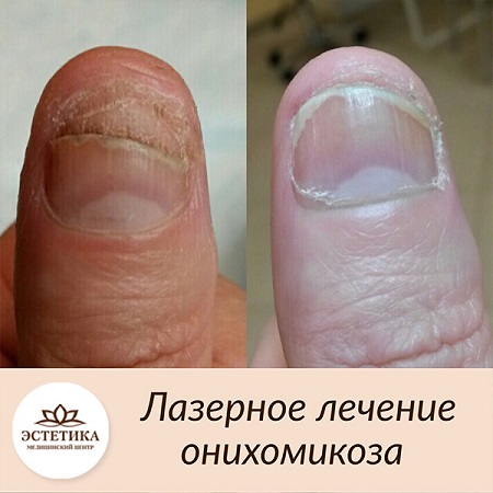 результат процедуры лечения ОНИХОМИКОЗА