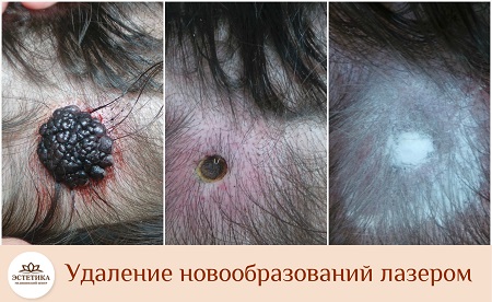 результат процедуры удаления новообразования