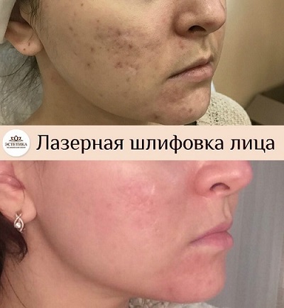 лазерная шлифовка лица, результат