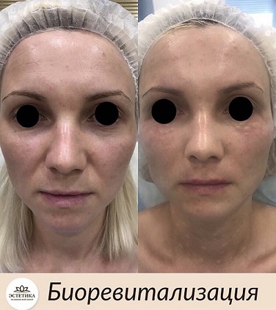 результат процедуры