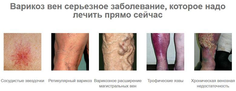 стадии варикоза