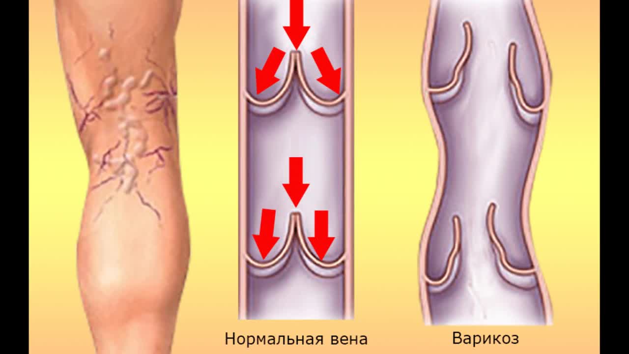варикозное расширение вен