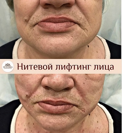 результат процедуры