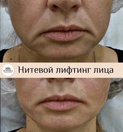 результат процедуры лифтинга Aptos