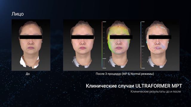 Ультраформер