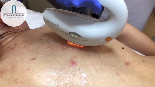 Эффективные методы лечения акне
