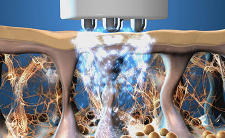 TriPollar RF