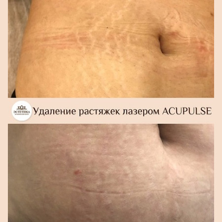 Лазер AcuPulse СО2