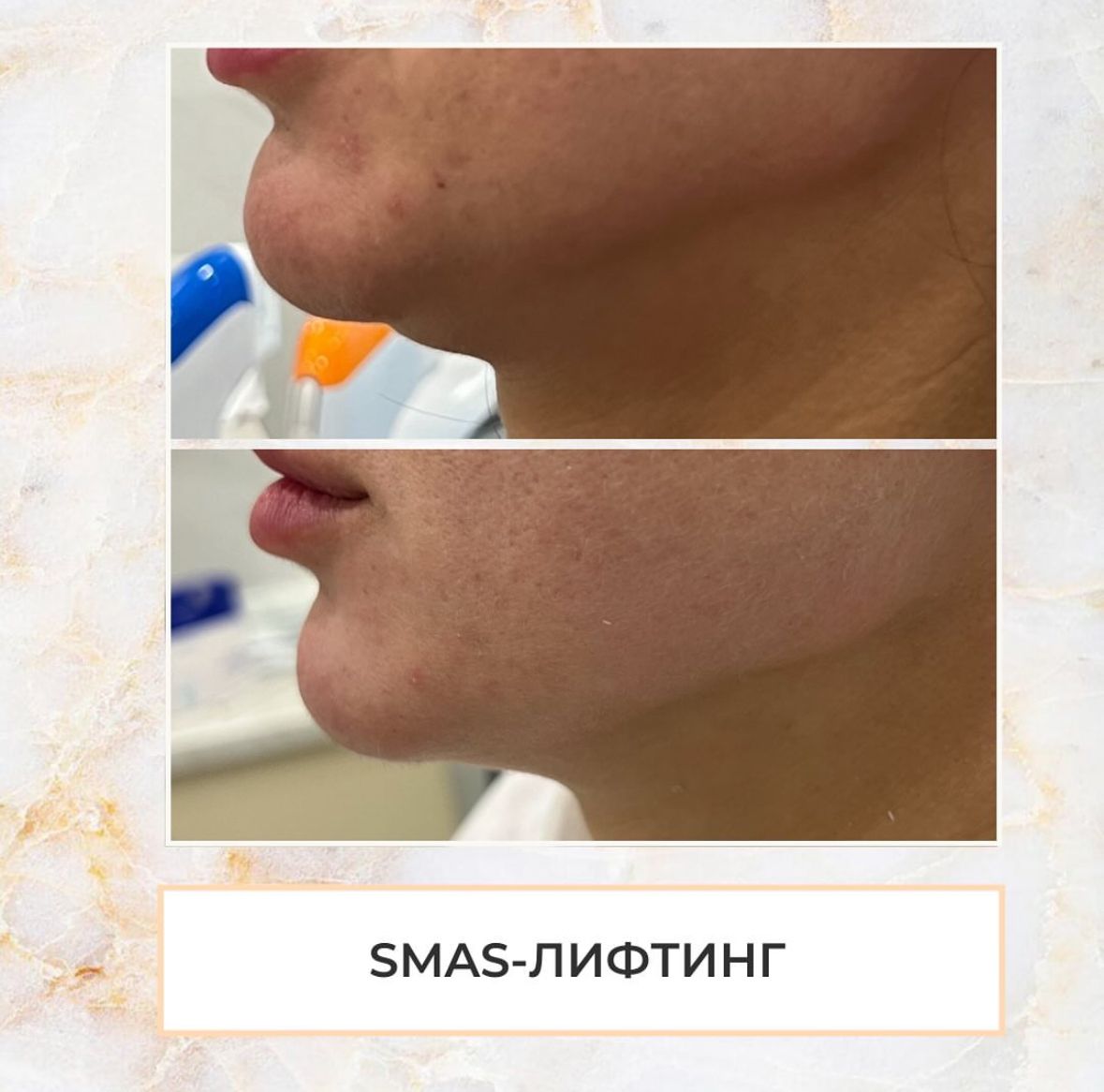 Smas лифтинг Ultraformer MPT