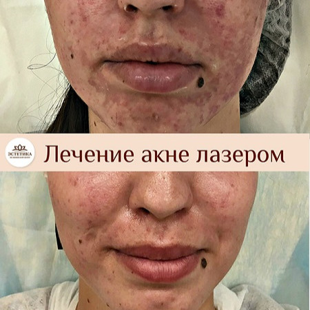 Лазер AcuPulse СО2