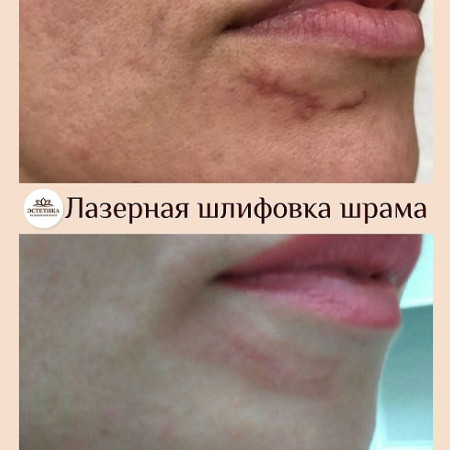Лазер AcuPulse СО2