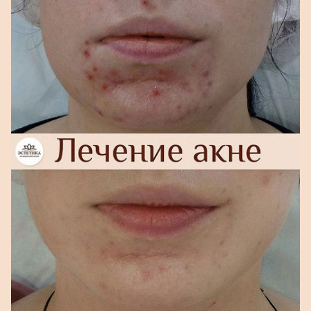 Лазер AcuPulse СО2