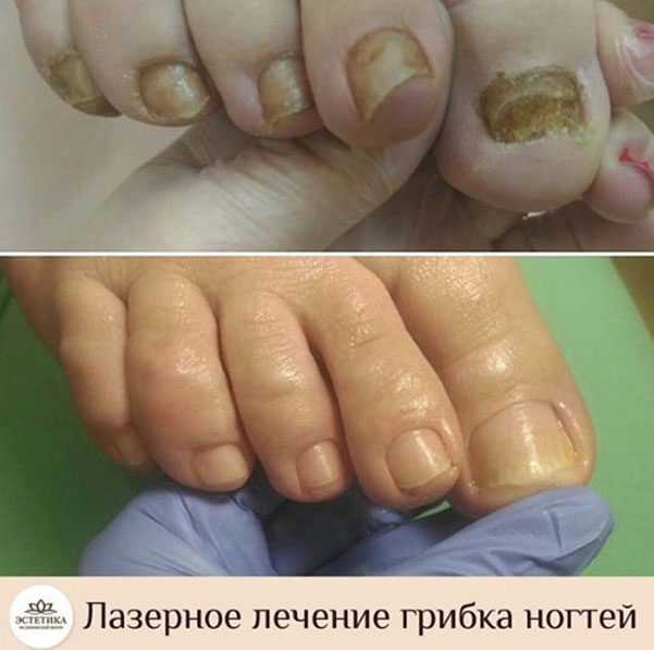 Лечение грибка ногтей