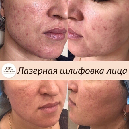 Лазер AcuPulse СО2