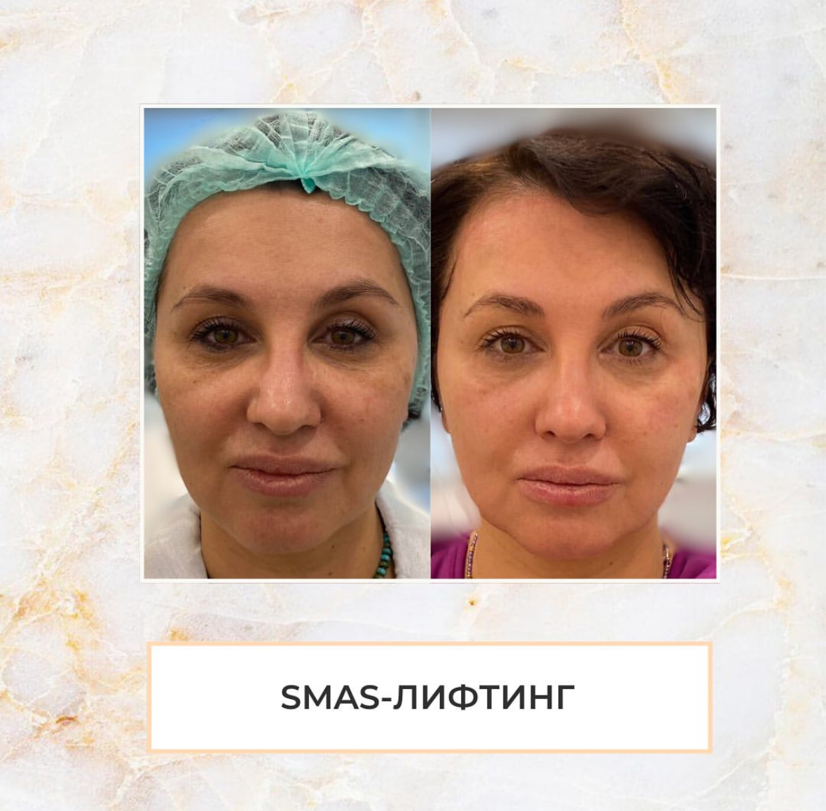 Smas лифтинг Ultraformer MPT