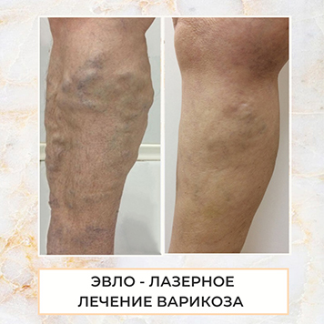 ЭВЛК