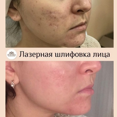 Лазер AcuPulse СО2
