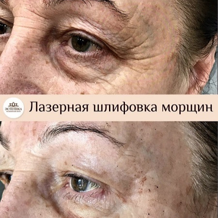 Лазер AcuPulse СО2