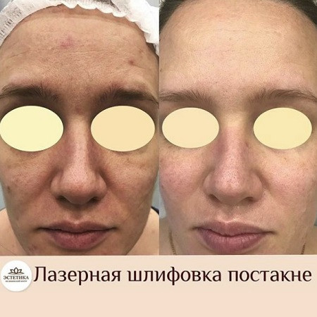Лазер AcuPulse СО2